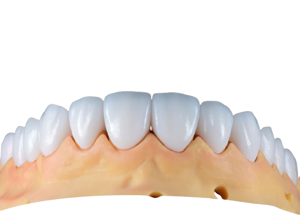 EMax Veneer