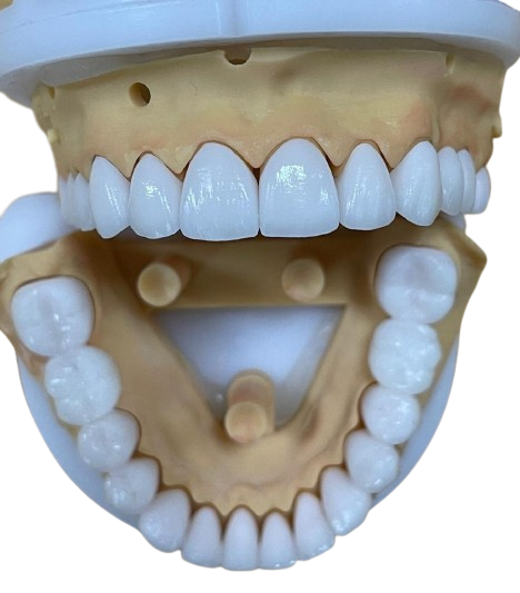 Full Contour Zirconia